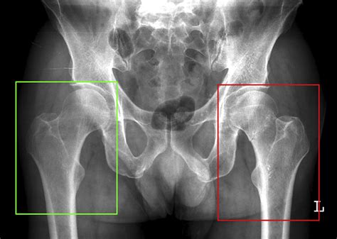 Detection and localisation of hip fractures on anteroposterior ...