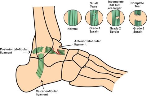 Anterior Drawer Test of the Ankle | Drawer test, Ankle surgery, Ankle ...