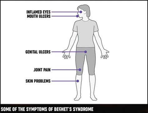 Behçet's Disease - Mata Clinic & Optometrist Blog