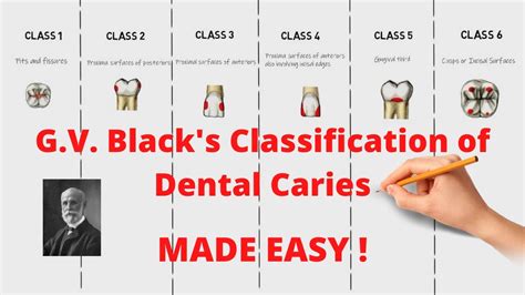 G.V. Black's Classification of Dental Caries (Quick and Complete ...