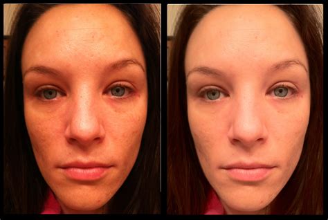 My Results : 3 Months of Tretinoin for Acne ...