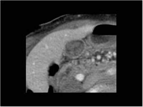 Abdomen and retroperitoneum | 1.2 Gallbladder and bile ducts : Case 1.2 ...