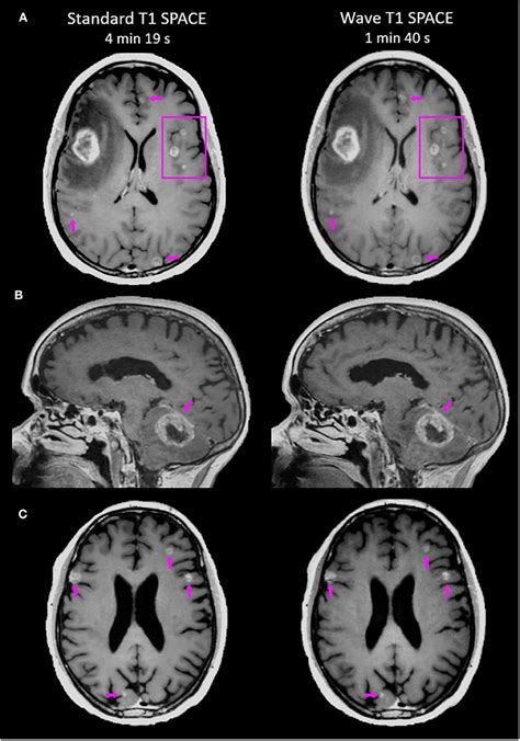 Frontiers | Accelerated Post-contrast Wave-CAIPI T1 SPACE Achieves ...