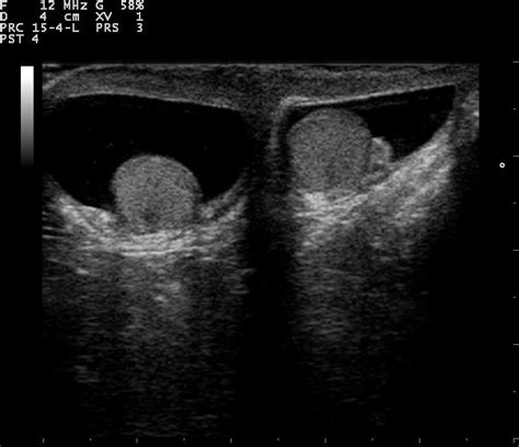 Ultrasound Imaging of Scrotum