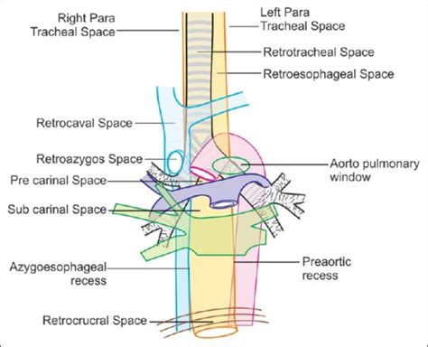 A coronal view of spaces around trachea and esophagus i | Open-i