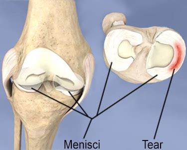 Lateral Meniscal Tear