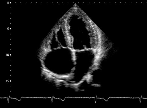 Use of the Echocardiogram to Define the Presence, Extent, and Etiology ...