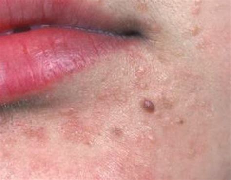 Flat Warts on Face - Pictures, Treatment, Causes, Removal