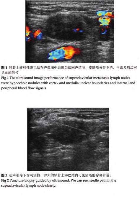 The ultrasound image performance of supraclavicular metastasis lymph ...