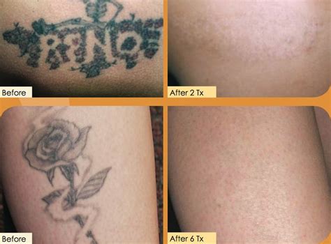 7 best Dermabrasion Tattoo Removal images on Pinterest | Laser tattoo ...