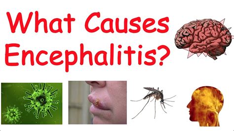 Encephalitis (Brain Inflammation) | Causes, Symptoms, Diagnosis ...