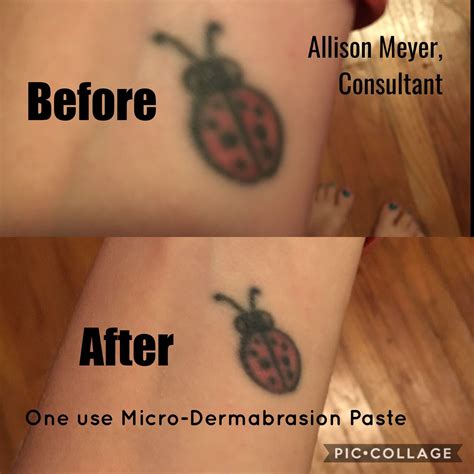 Rodan + Fields Micro-Dermabrasion Paste tattoo before and after results ...