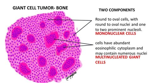 GIANT CELL TUMOR- BONE - Pathology Made Simple