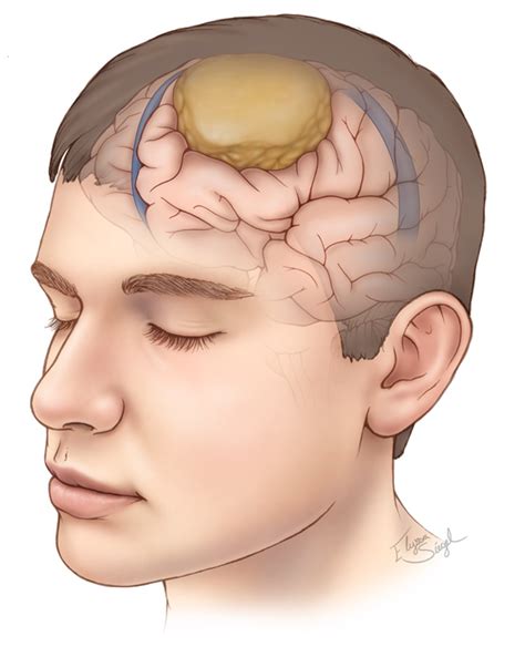 Meningioma | Expert Surgeon | Aaron Cohen-Gadol, MD