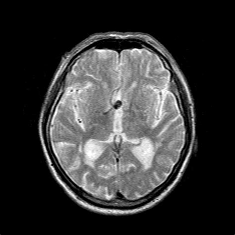 Anterior communicating artery aneurysm | Image | Radiopaedia.org