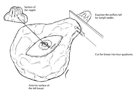 Breast Mastectomy : Surgical Pathology Dissection