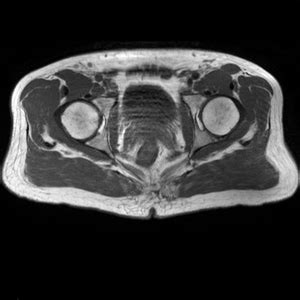 Basic-hip-mri