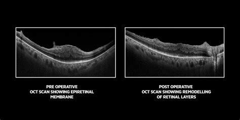 Epiretinal Membrane Symptoms, Causes, and Treatment