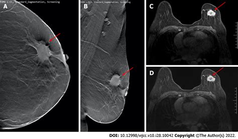 Study Of Role Of Digital Breast Tomosynthesis Over Digital, 42% OFF