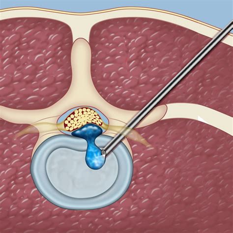 Herniated Disc Surgery Video