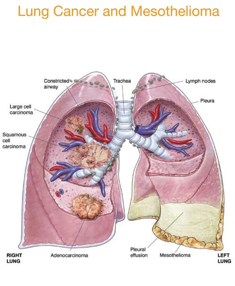 Mesothelioma Symptoms Near Death - September 2020 Uab Institute For ...