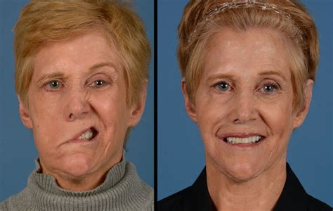 How Susan got her smile back: A journey overcoming facial paralysis ...