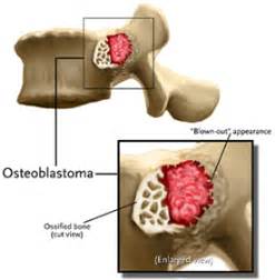 osteoblastoma - NeurotexasNeurotexas