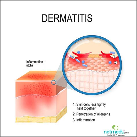 Contact Dermatitis: Causes, Symptoms and Treatment | Netmeds