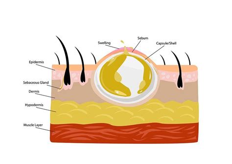 Abscess Drainage » Palmer General Surgeon | Mat-Su Surgical Associates ...