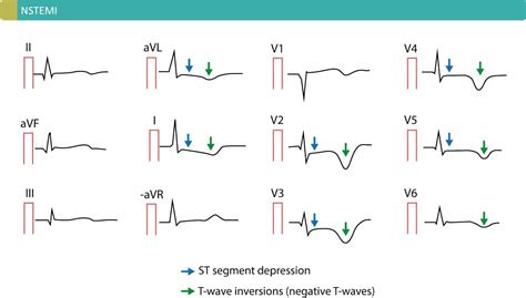 NSTEMI (Non ST Elevation Myocardial Infarction) & Unstable Angina ...