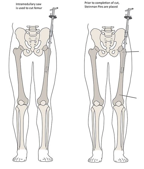 Femoral Osteotomy: Anteversion, Retroversion, Surgery | HSS