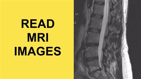 Lumbar Spine Mri Bulging Disc