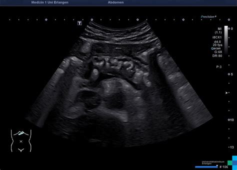 Chronic pancreatitis – Atlas of Ultrasound