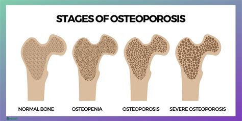 OSTEOPOROSIS - Symptoms, Causes, Risk Groups, Prevention and Treatment ...