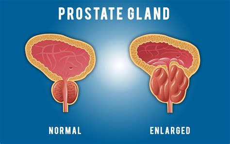 The Prostate Gland | Urologists in Ocala, FL