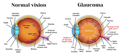 What is Glaucoma? Learn about Glaucoma | Glaucoma Resources