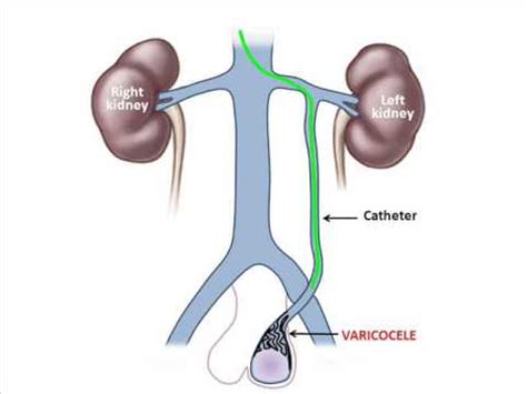 Varicocele embolization - YouTube