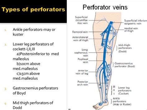 vericose veins