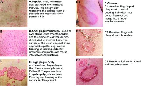 Annular Lesions: Diagnosis And Treatment AAFP, 40% OFF