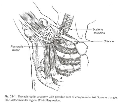 Thoracic Outlet Syndrome