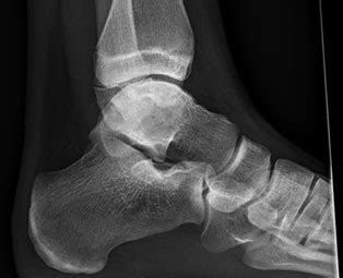 Clinical Practice Guidelines : Talus Fractures: Emergency Department