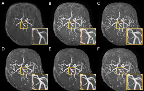 Super-resolution application of GAN on brain time-of-flight MR ...