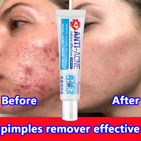 Pimple Remover Acne Scar Remover anti acne and pimples Repair Pimple ...