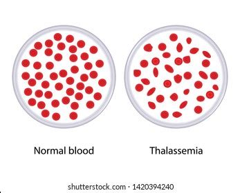 3,016 Thalassemia Images, Stock Photos & Vectors | Shutterstock