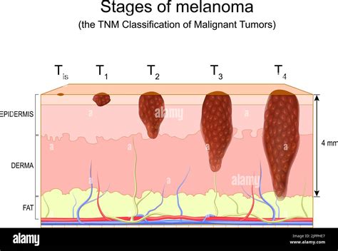 Melanoma Skin Cancer Diagram