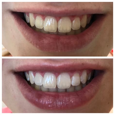 Before and After — Marshall Dental