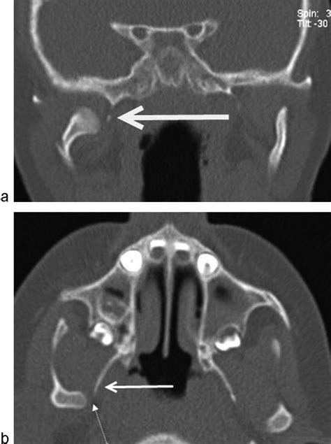 Pterygoid Plate Fracture