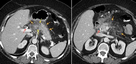 Acute pancreatitis - Radiology at St. Vincent's University Hospital