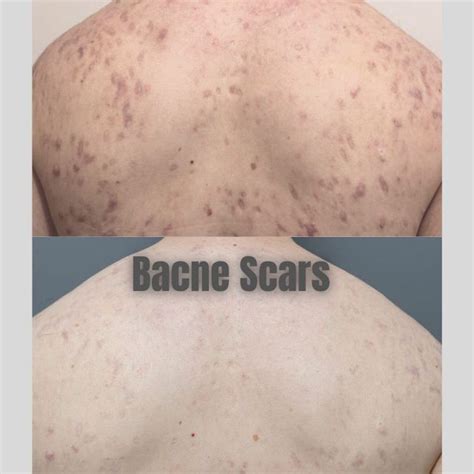 Bacne Scars Treatment