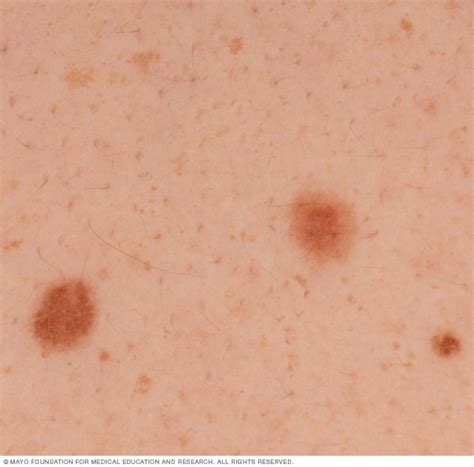 Melanoma - Symptoms and causes - Mayo Clinic